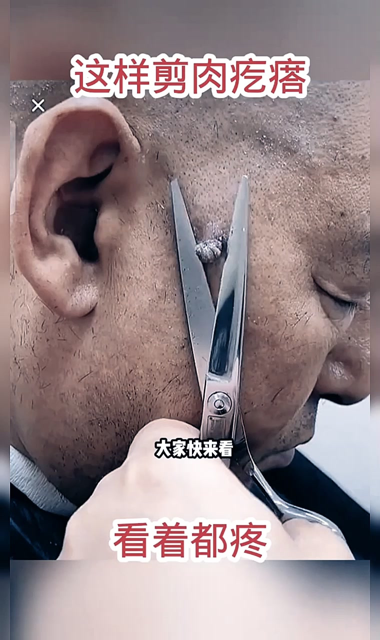 这样剪肉疙瘩,看着都疼!
