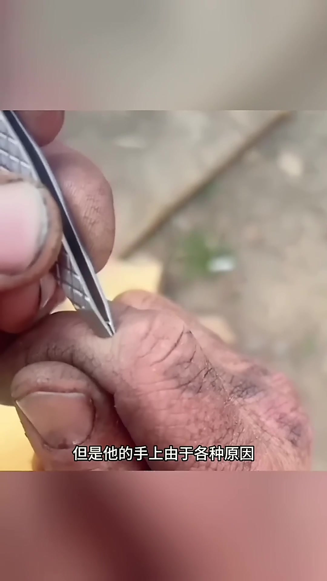 粗糙的双手,长了一个肉刺