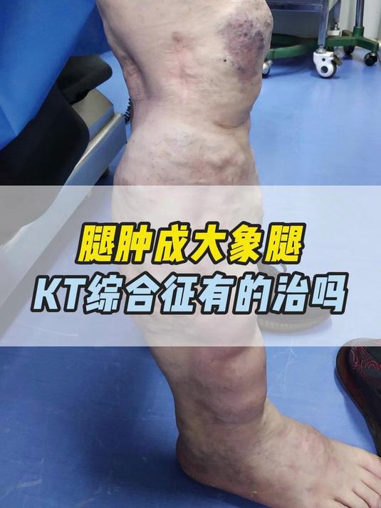 腿肿成大象腿，KT综合征有的治吗