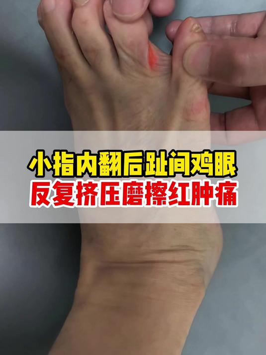 小指内翻后趾间鸡眼,反复挤压磨擦红肿痛