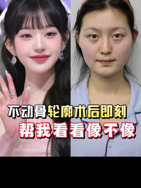 真实案例反馈:阔面脸1小时逆袭鹅蛋脸,没想到变化那么大!