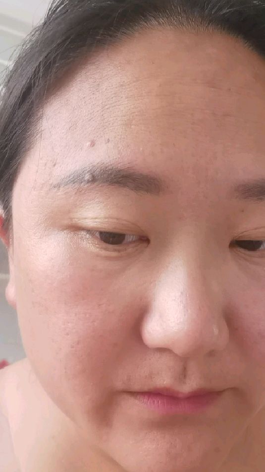 三次纹眉后,眉毛里面长了个东西,可能是病毒感染引起的