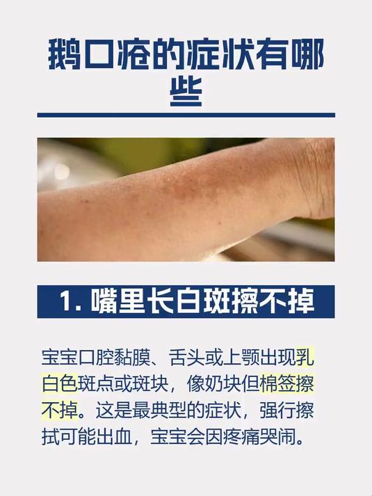 鹅口疮的症状有哪些