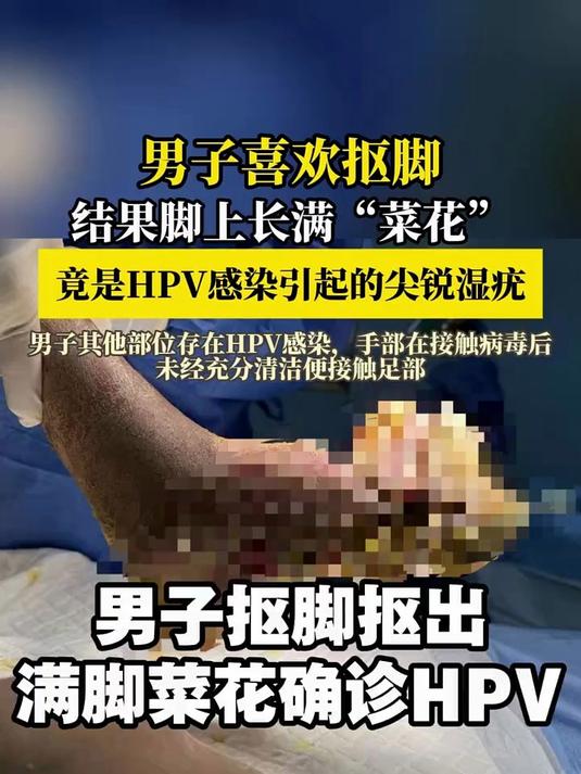 男子抠脚抠出满脚菜花确诊HPV