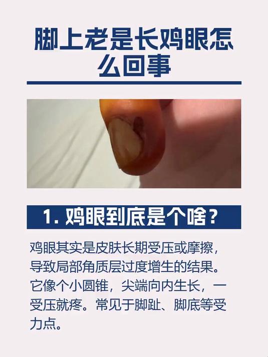 脚上老是长鸡眼怎么回事