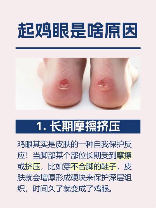 #马上健康过大年#起鸡眼是啥原因