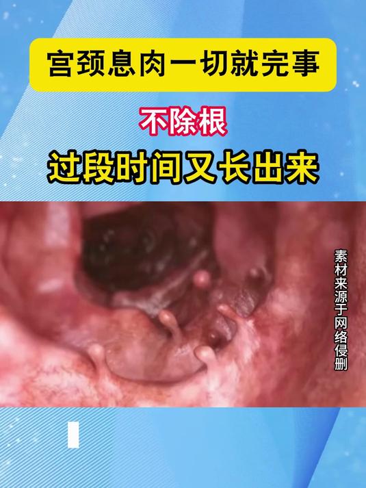宫颈息肉一切就完事?不除根,过段时间又长出来#健康向阳计划#