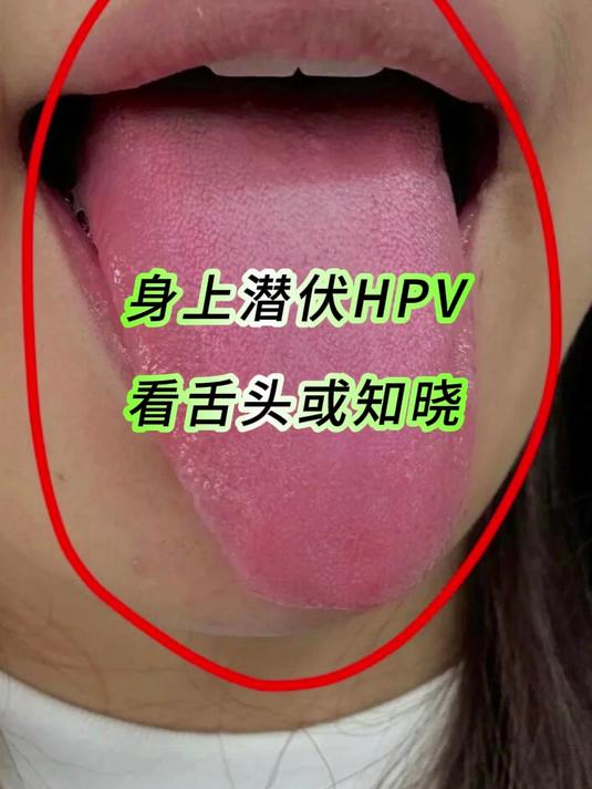 身上潜伏HPV,看舌头或知晓