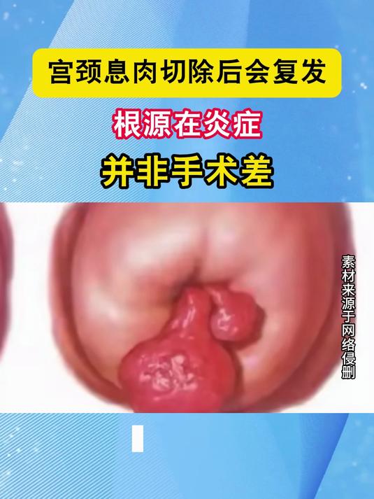 宫颈息肉切除后会复发?根源在炎症,并非手术差#健康向阳计划#