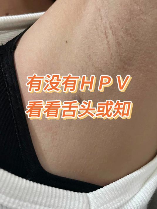 有没有HPV,看看舌头或知