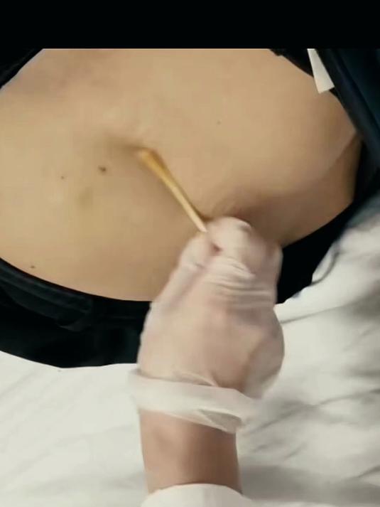 肌肉注射技巧 执笔式握针，垂直90度进针，新手牢记！