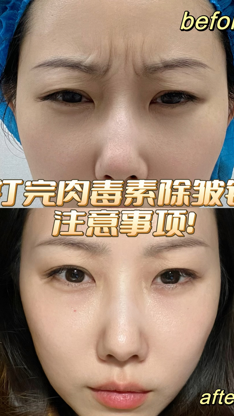 打完肉毒素除皱针的注意事项