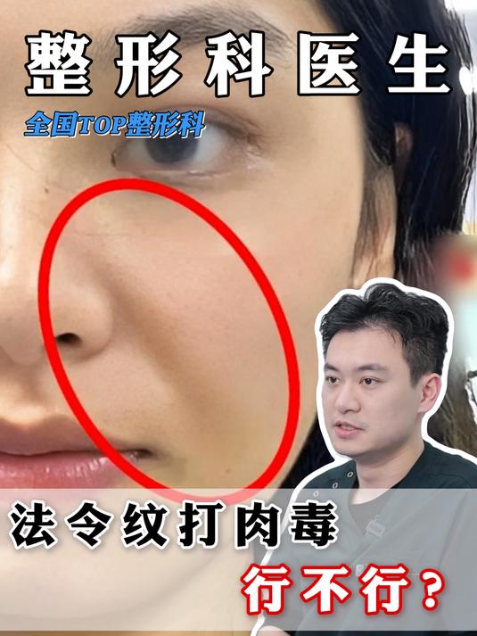 法令纹可以打肉毒吗?