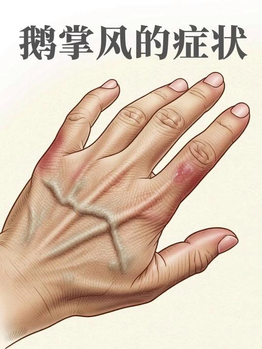 鹅掌风的症状