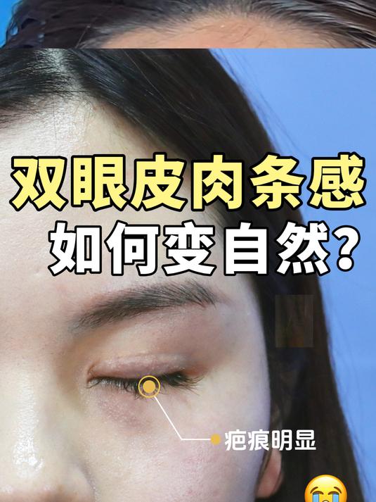双眼皮肉条感,疤痕增生明显,怎么拯救?