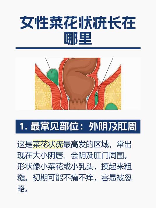 女性菜花状疣长在哪里