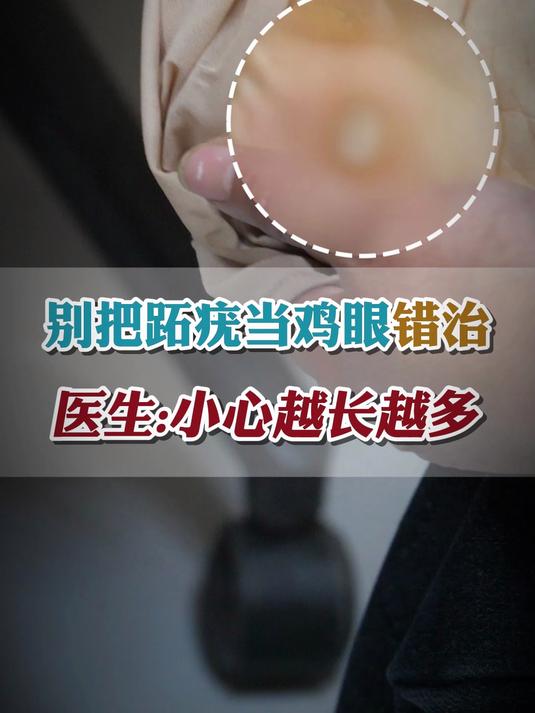 别把跖疣当鸡眼错治医生小心越长越多!