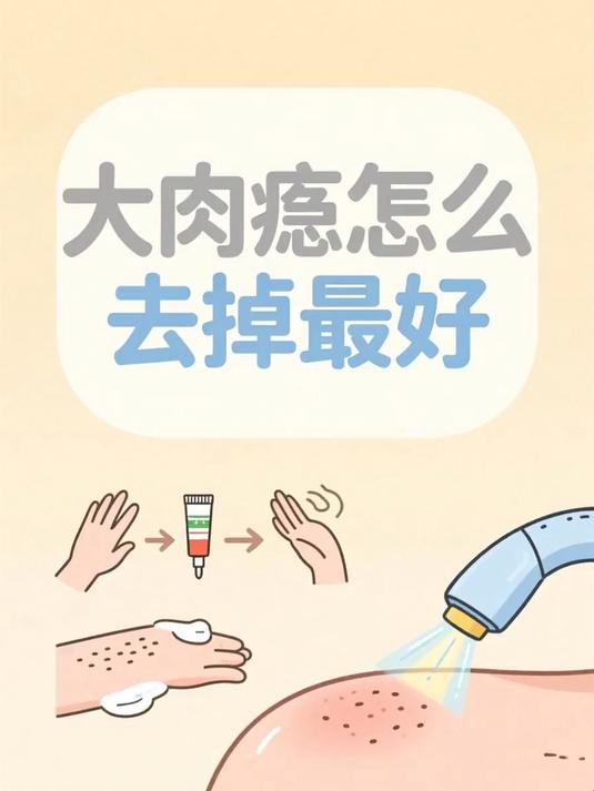 大肉痣怎么去掉最好