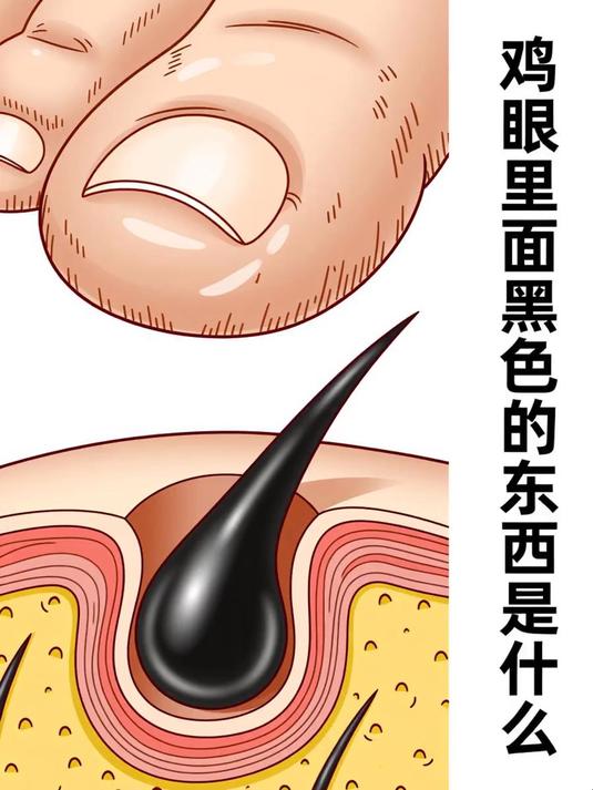 鸡眼里面黑色的东西是什么