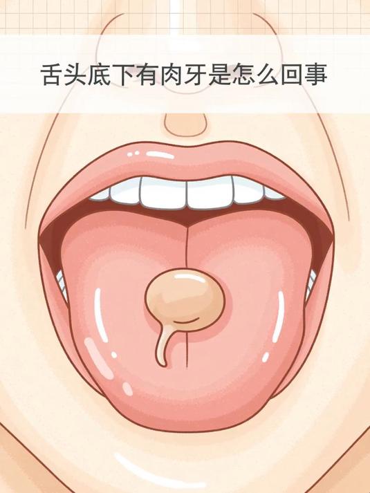 舌头底下有肉芽是怎么回事 #健康扬帆季#