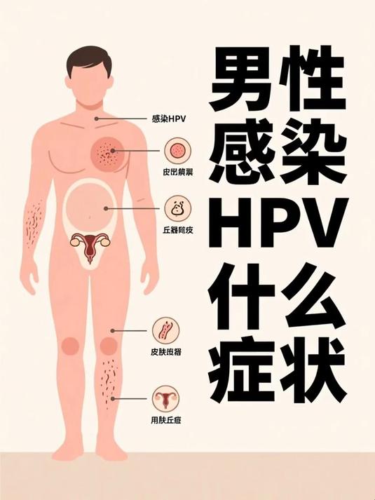 男性感染hpv什么症状
