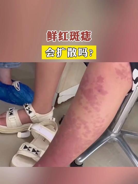 鲜红斑痣会扩散吗？