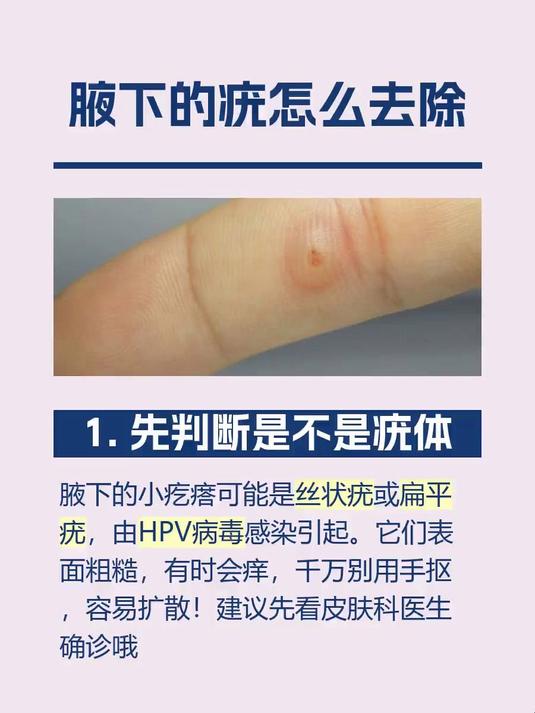 腋下的疣怎么去除