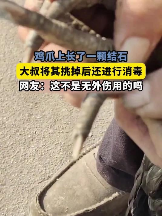 鸡爪上长了一颗结石,大叔将其挑掉后还进行消毒