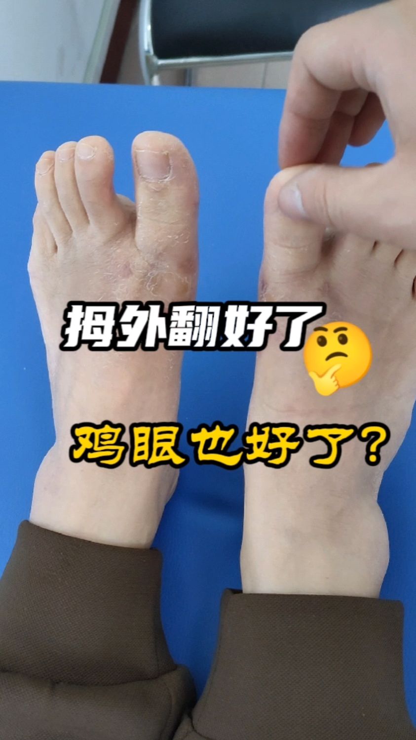 拇外翻微创脚好了,鸡眼也好了?