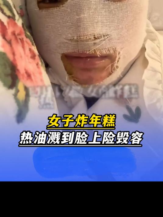 女子炸年糕热油溅到脸上险毁容,被烫伤后紧急冰敷,目前好很多