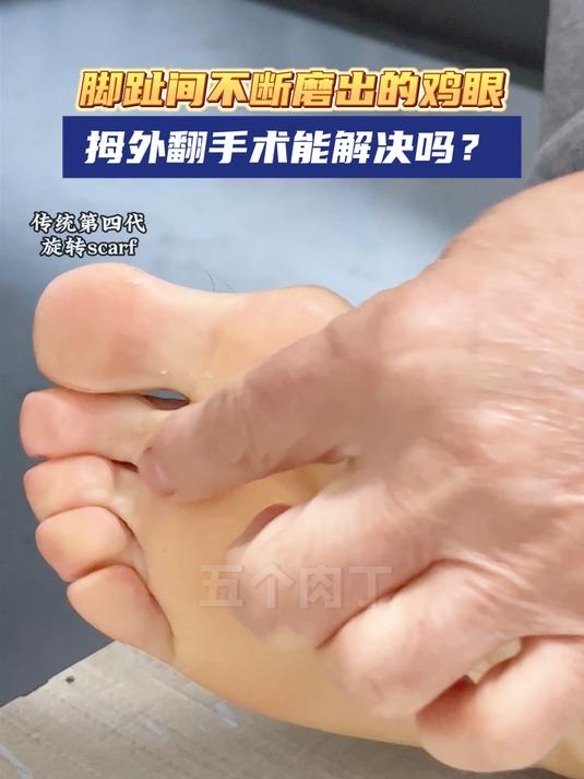 脚趾间不断磨出的鸡眼,拇外翻手术能解决吗?