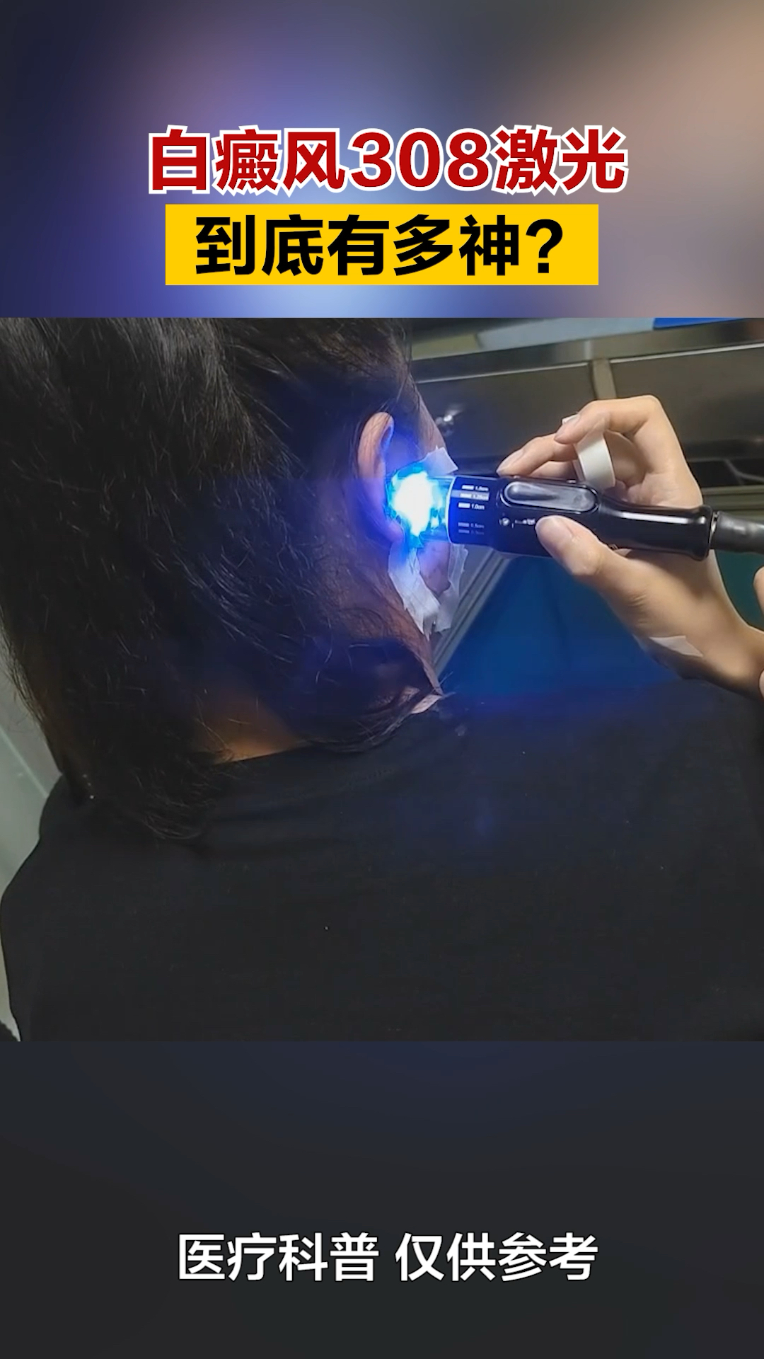 白癜风308激光,到底有多神?