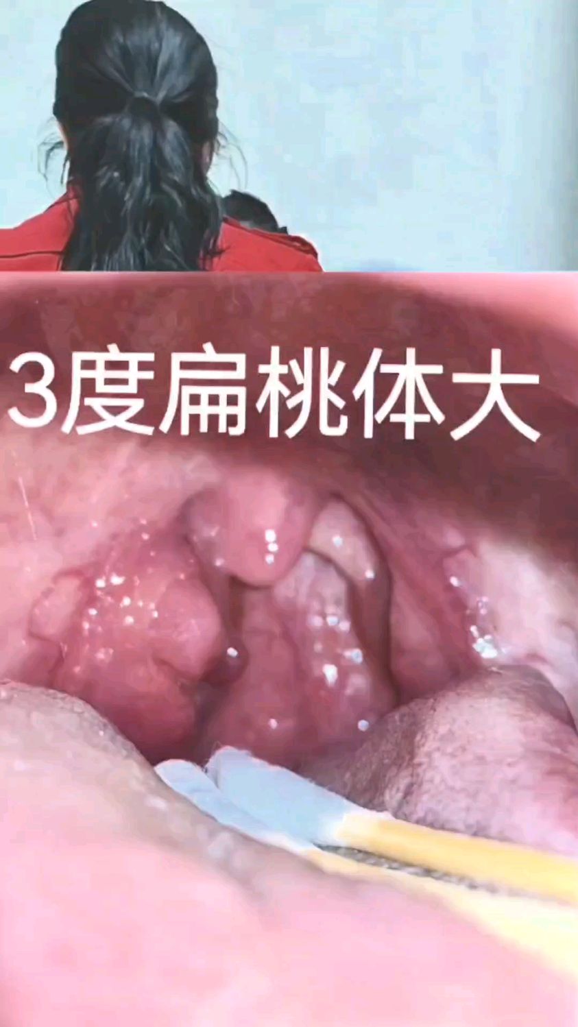 右侧扁桃体增生肥厚,一周前觉异物感,今天开始烙治,效果显著,避免了手术切除。