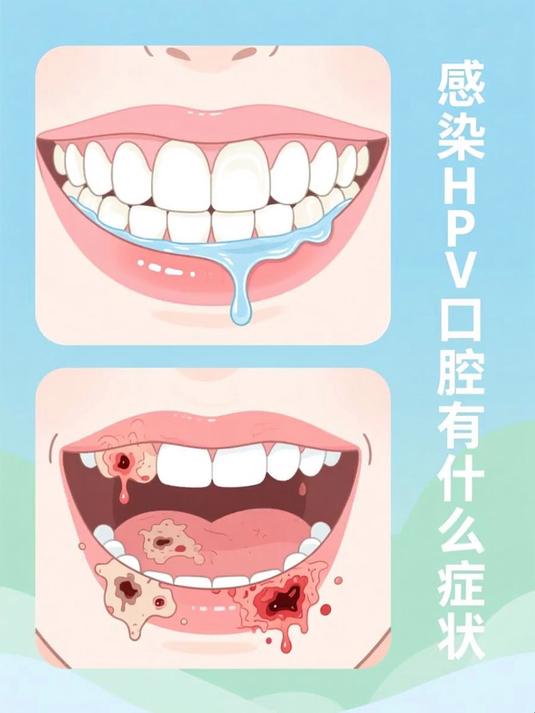 感染hpv口腔有什么症状