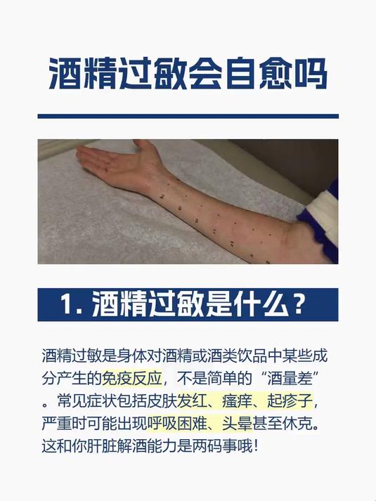 酒精过敏会自愈吗