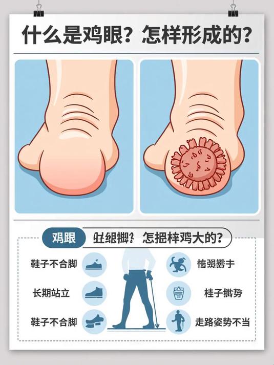 什么是鸡眼怎样形成的