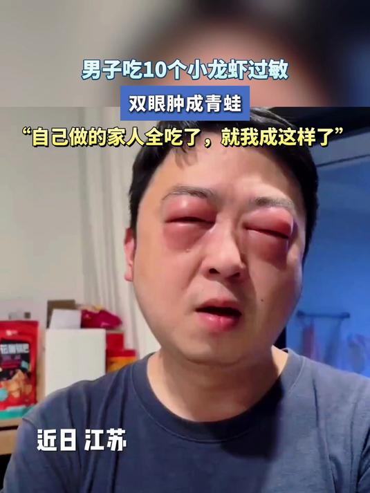 男子吃10个小龙虾过敏,双眼肿成青蛙