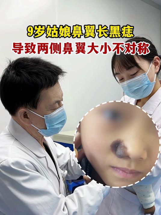 9岁姑娘鼻翼长黑痣,导致两侧鼻翼大小不对称