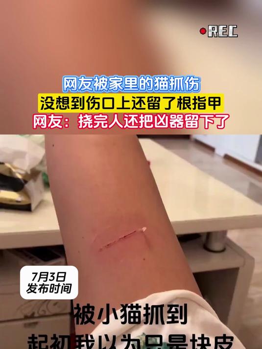 网友被家里的猫抓伤,没想到伤口上还留了根指甲