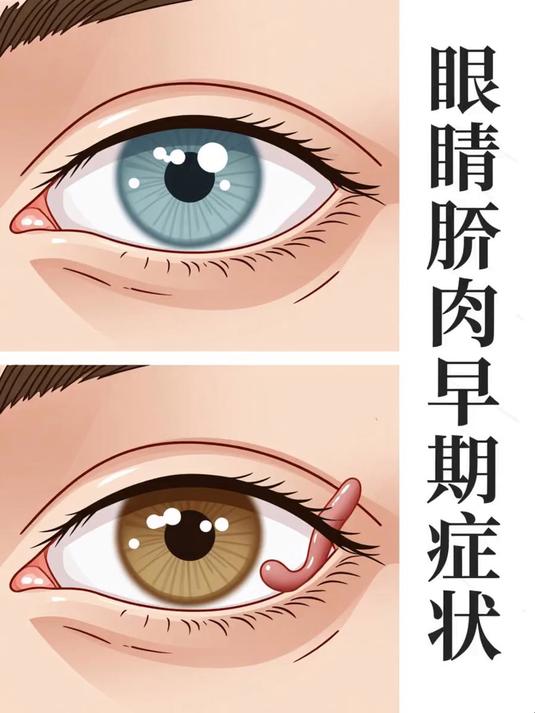 眼睛胬肉早期症状