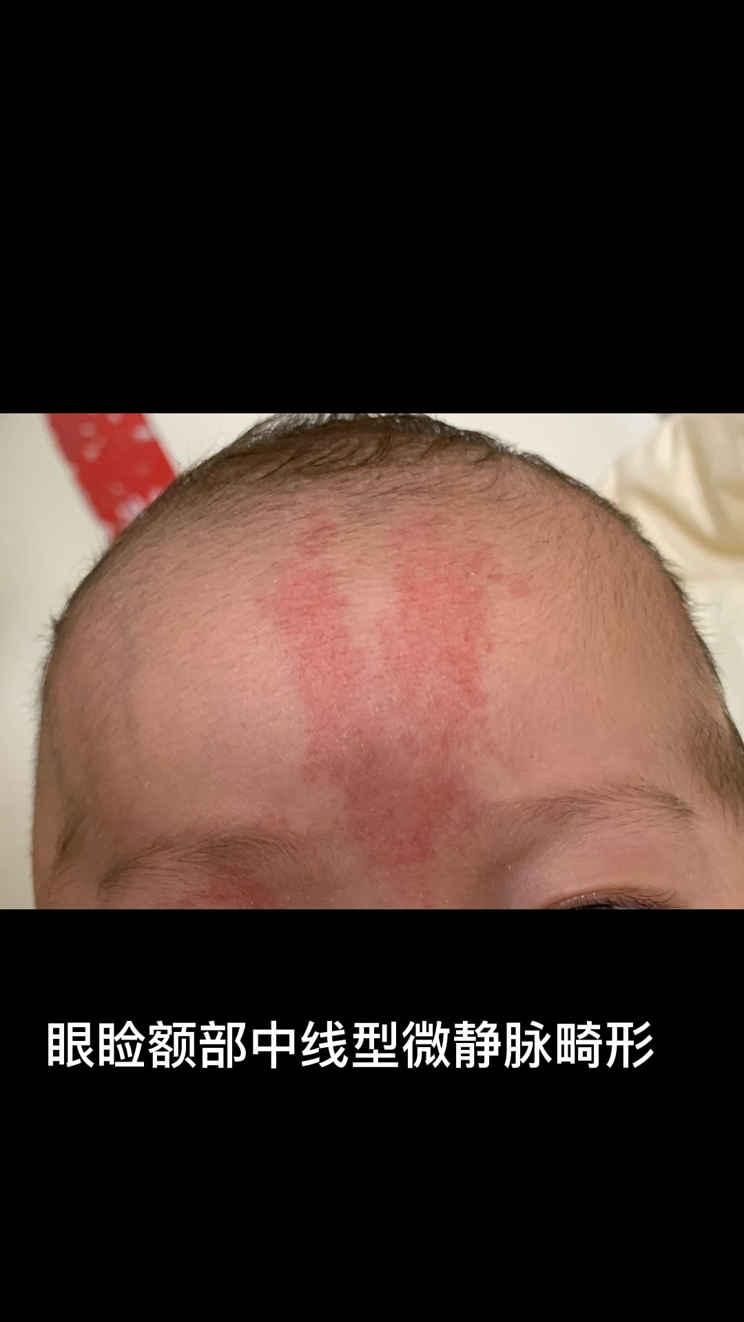 中线型微静脉畸形/鲑鱼斑/V型红斑医学科普