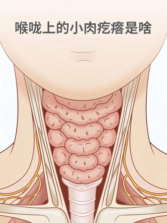 喉咙上的小肉疙瘩是啥 #健康扬帆季#