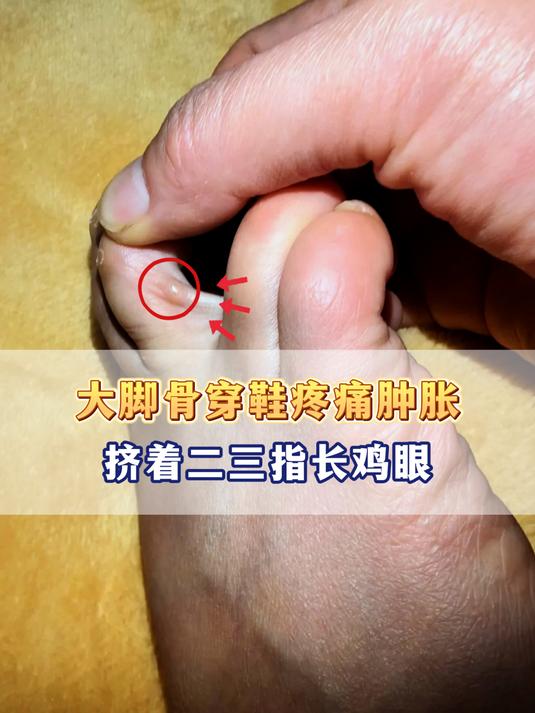 大脚骨穿鞋疼痛肿胀,挤着二三指长鸡眼,打破遗传性拇外翻看这里