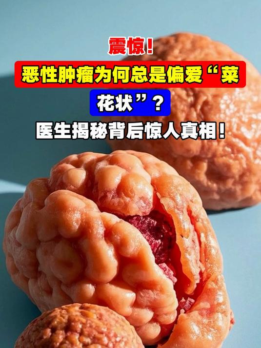 震惊!恶性肿瘤为何总是偏爱“菜花状”?医生揭秘背后惊人真相