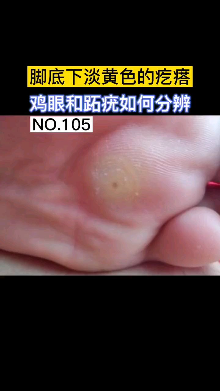 脚底下淡黄色的疙瘩-鸡眼和跖疣如何分辨
