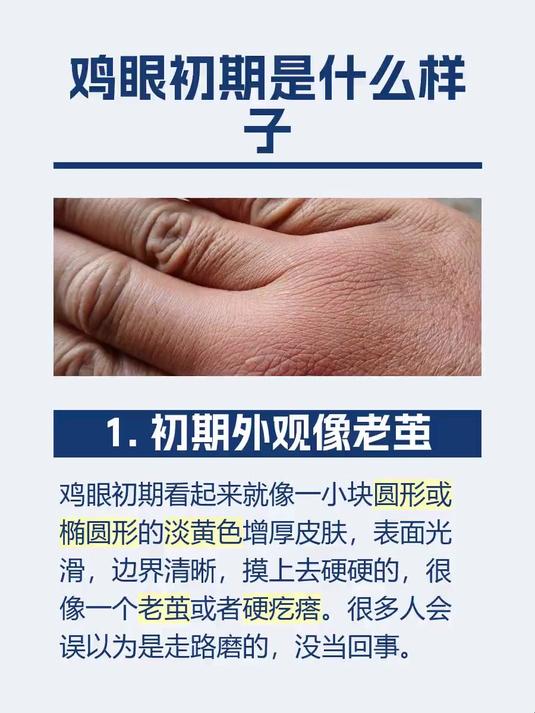 鸡眼初期是什么样子