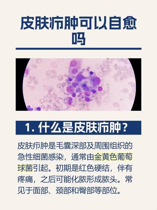 皮肤疖肿可以自愈吗