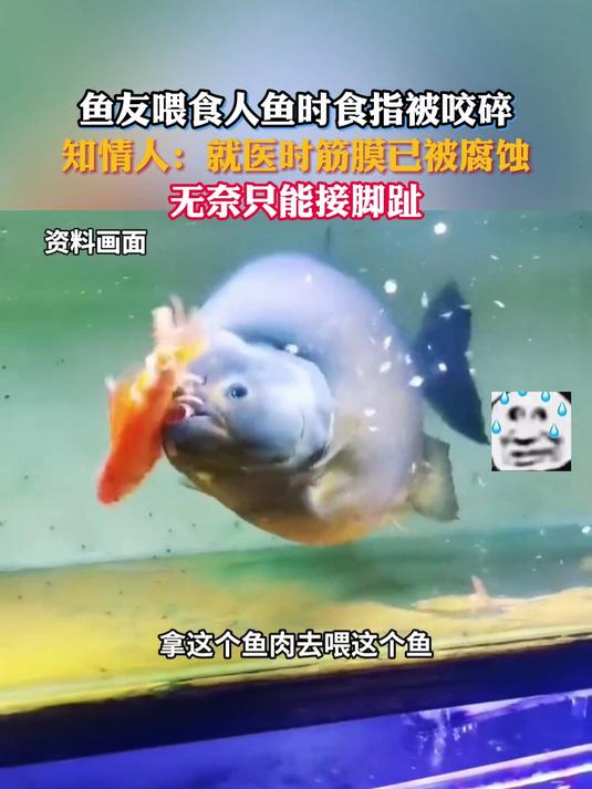 鱼友喂食人鱼时食指被咬碎,就医时筋膜已被腐蚀,无奈只能接脚趾