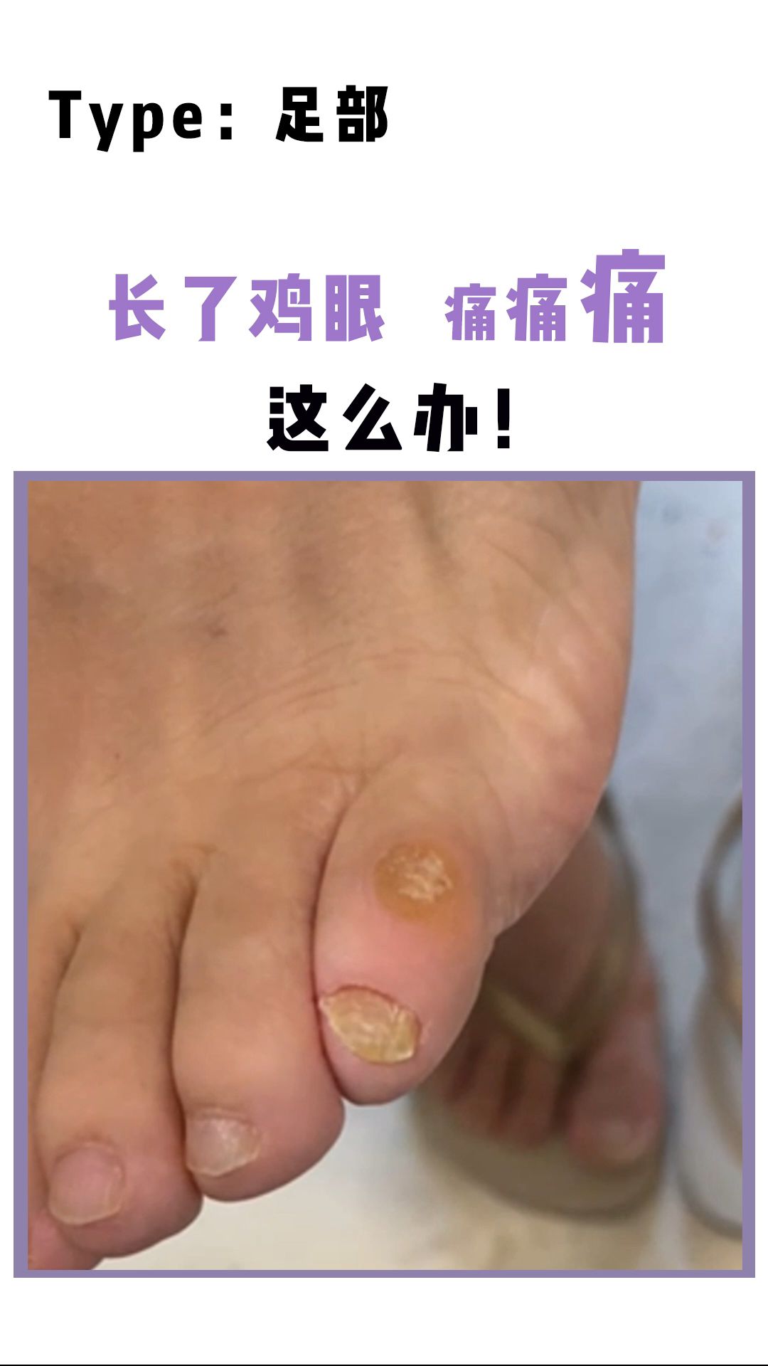 走路脚底非常痛,有可能你是长了鸡眼