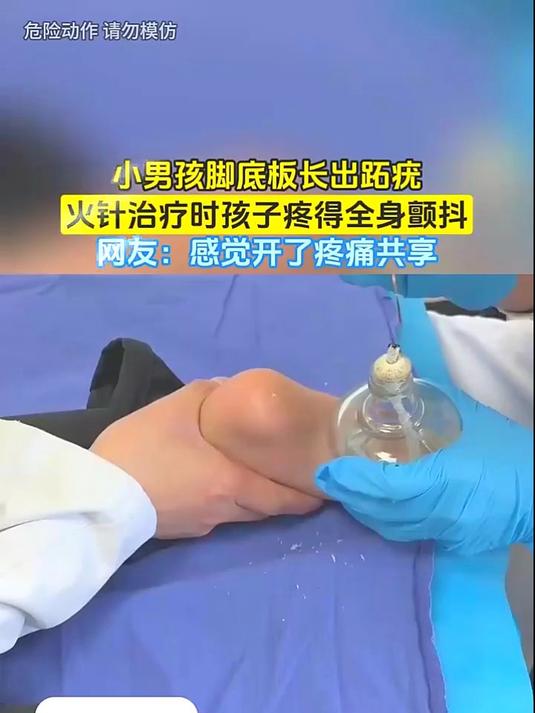小男孩脚底板长出跖疣，火针治疗时孩子疼得全身颤抖，网友：感觉开了疼痛共享